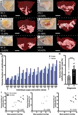 3D histopathology of stenotic aortic valve cusps using ex vivo microfocus computed tomography